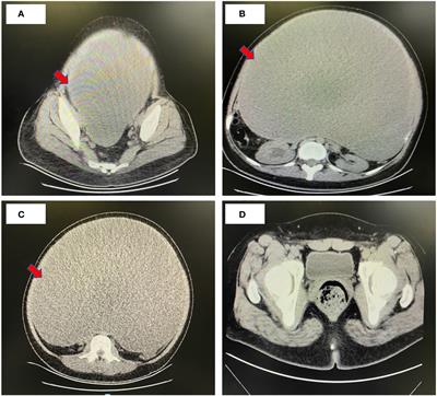 Giant mucinous cystadenocarcinoma of ovary in a young woman: a case report and review of literature